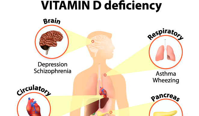 Vitamin D Deficiency and its Effect on Your Body